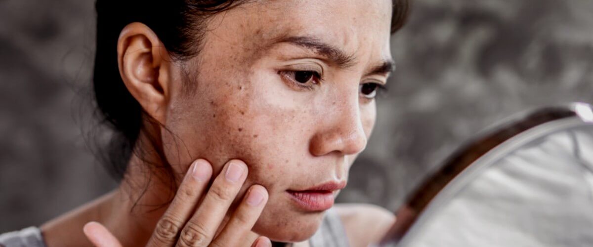 The commоn treatments for hyperpigmentation